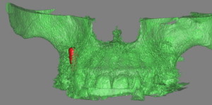 Il 3D ricavato dalla CBCT conferma il posizionamento fuori dall'osso dell'impianto