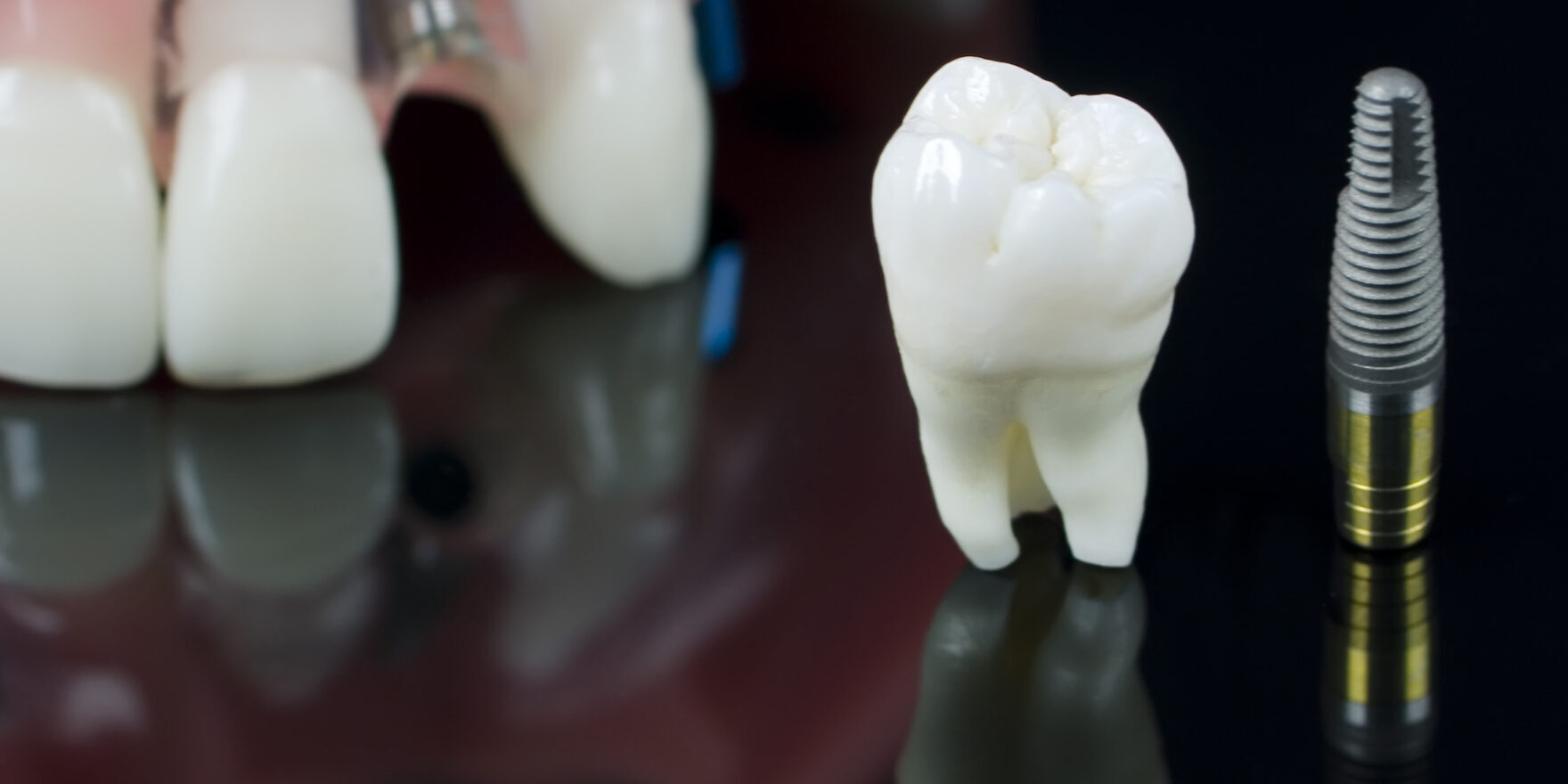 Real,Human,Wisdom,Tooth,,Dental,Implant,And,Plastic,Teeth,Model.