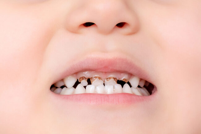 Close,Up,Of,Baby,Teeth,With,Caries.,Dental,Medicine,And